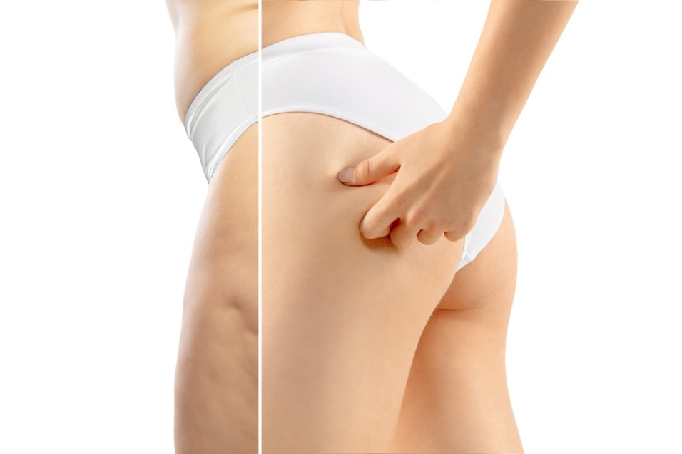 CELULITIS
