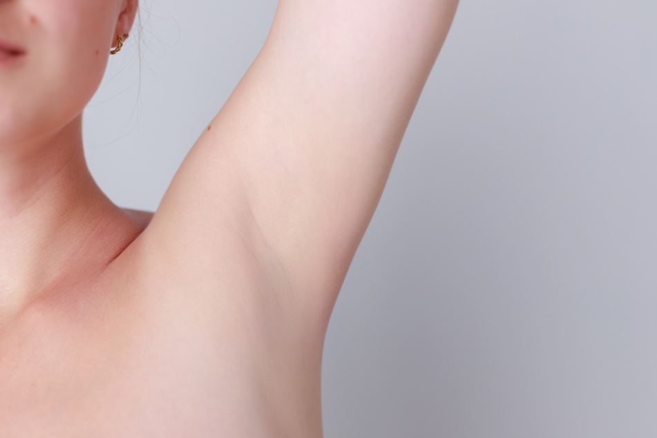 HIPERHIDROSIS