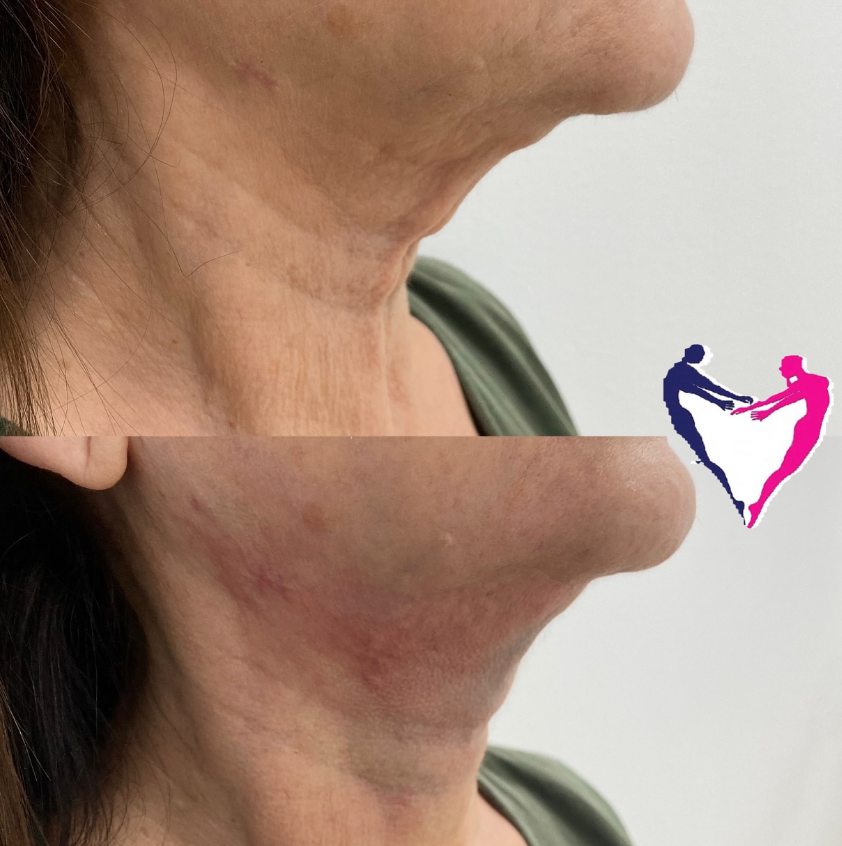 Centro Médico Ágape para eliminar la papada con el revolucionario tratamiento Endolift con técnica QUIMBLÁSER